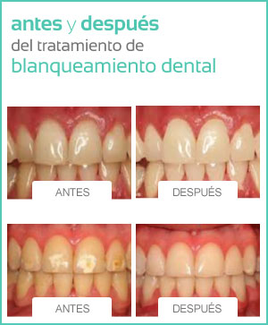 blanqueamiento dental